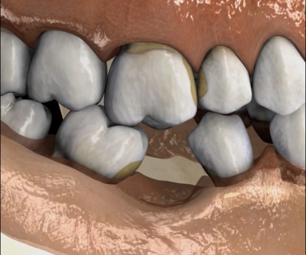 ¿Por qué reponer los dientes perdidos es crucial para tu salud?