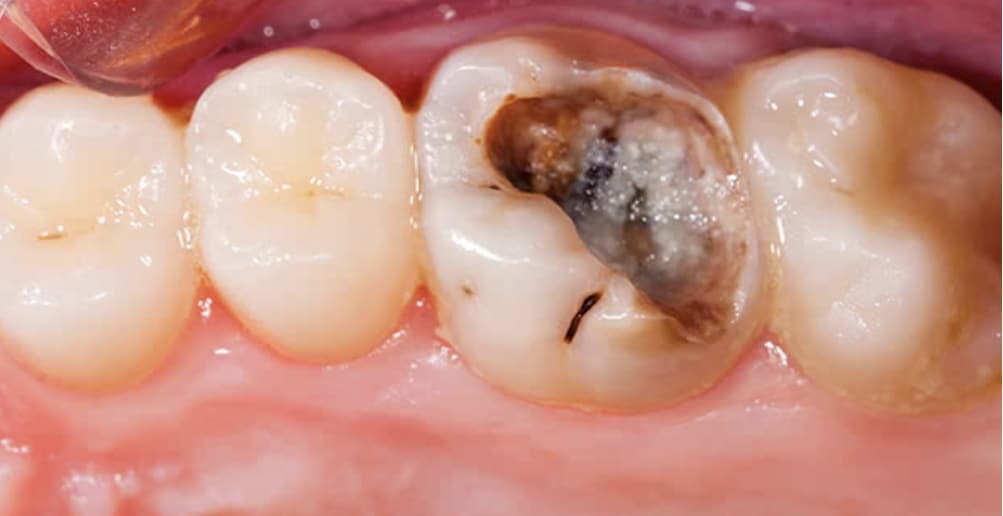 Caries Dentales, todo lo que necesitas saber.