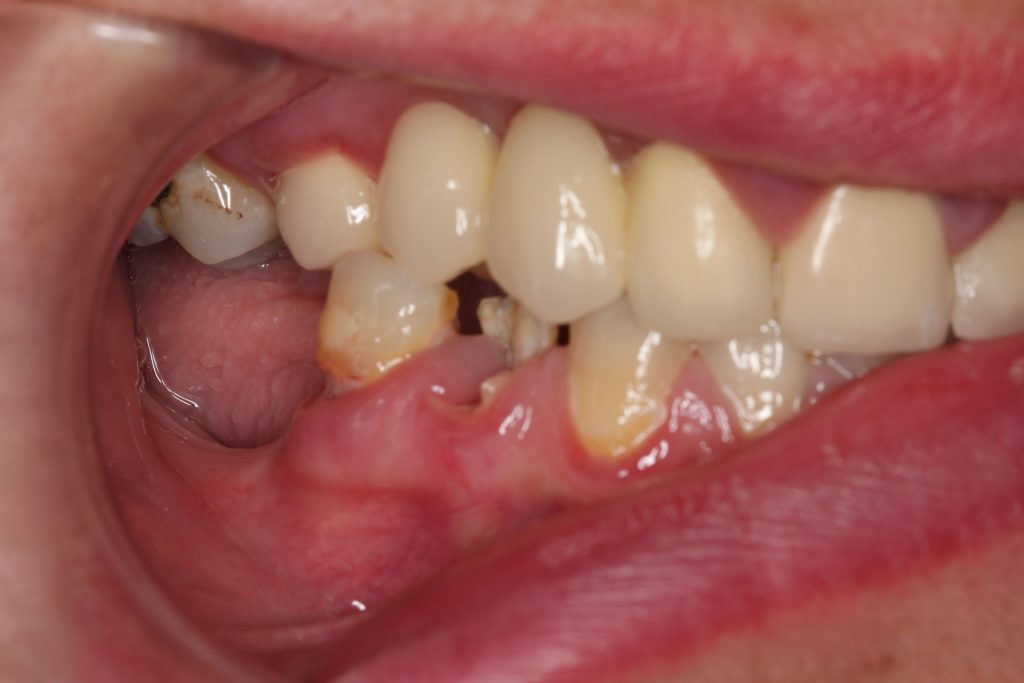 ¿Por qué reponer los dientes perdidos es crucial para tu salud?