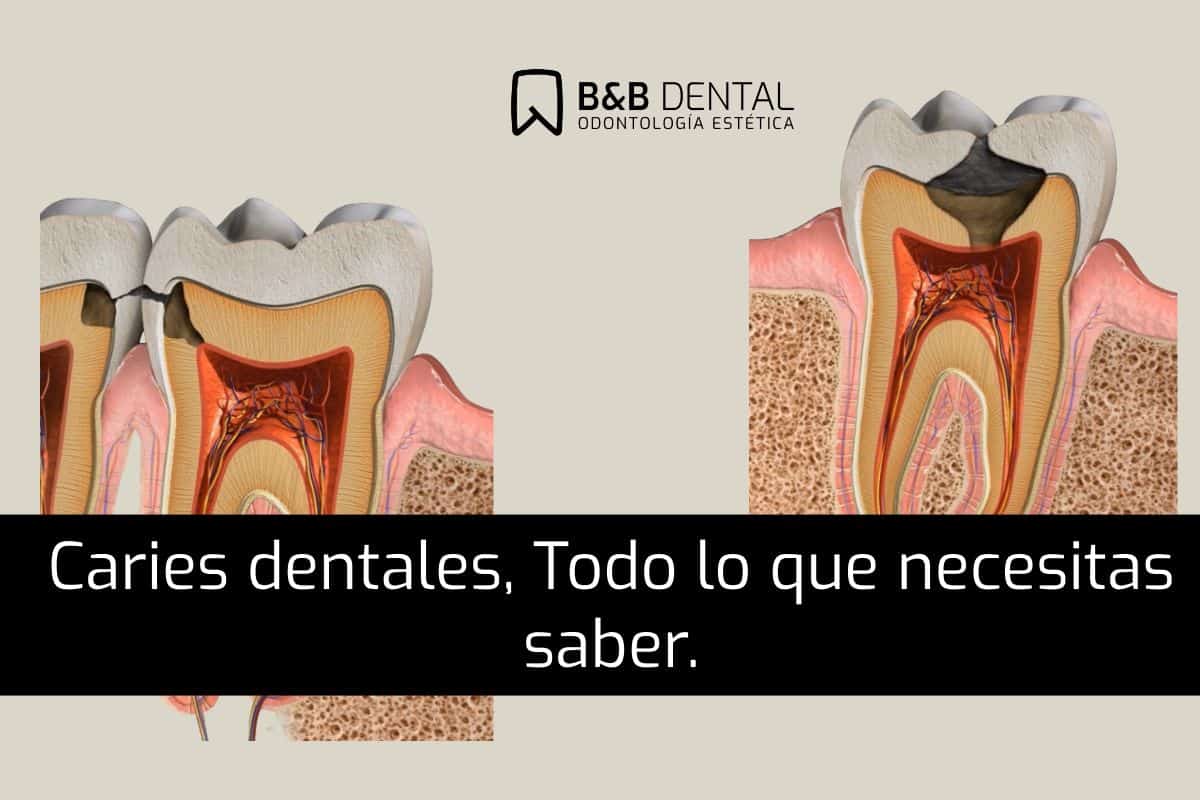 Caries dentales en Málaga