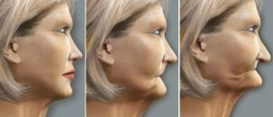 ¿Por qué el edentulismo es un gran problema y cómo solucionarlo?