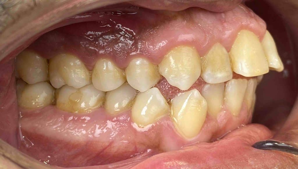 Apiñamiento dental: qué es, por qué ocurre y cómo se soluciona
