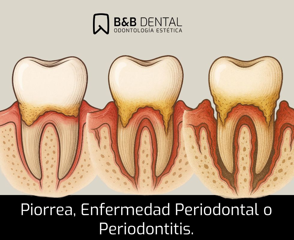 Periodoncia con el mejor dentista de Málaga
