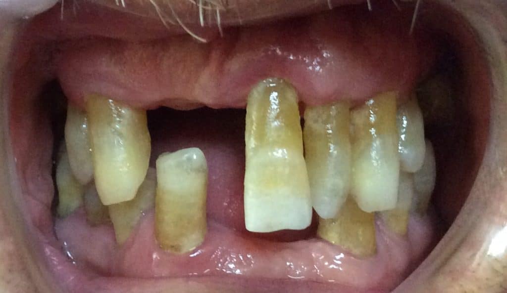 ¿ Qué es la piorrea o la enfermedad peridontal?