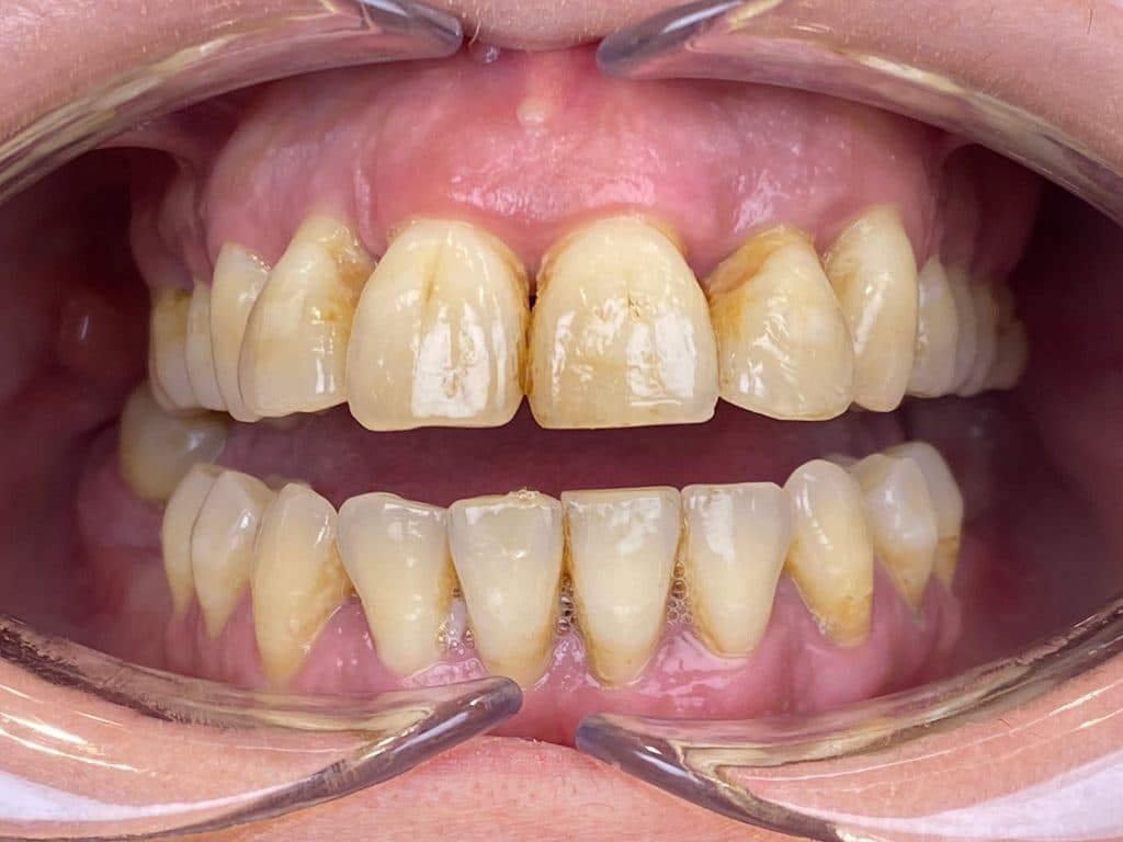 ¿ Qué es la piorrea o la enfermedad peridontal?