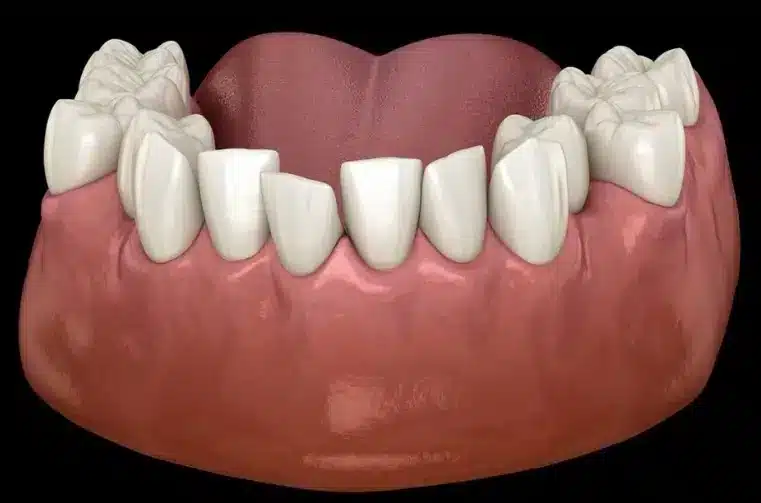 Apiñamiento dental: qué es, por qué ocurre y cómo se soluciona