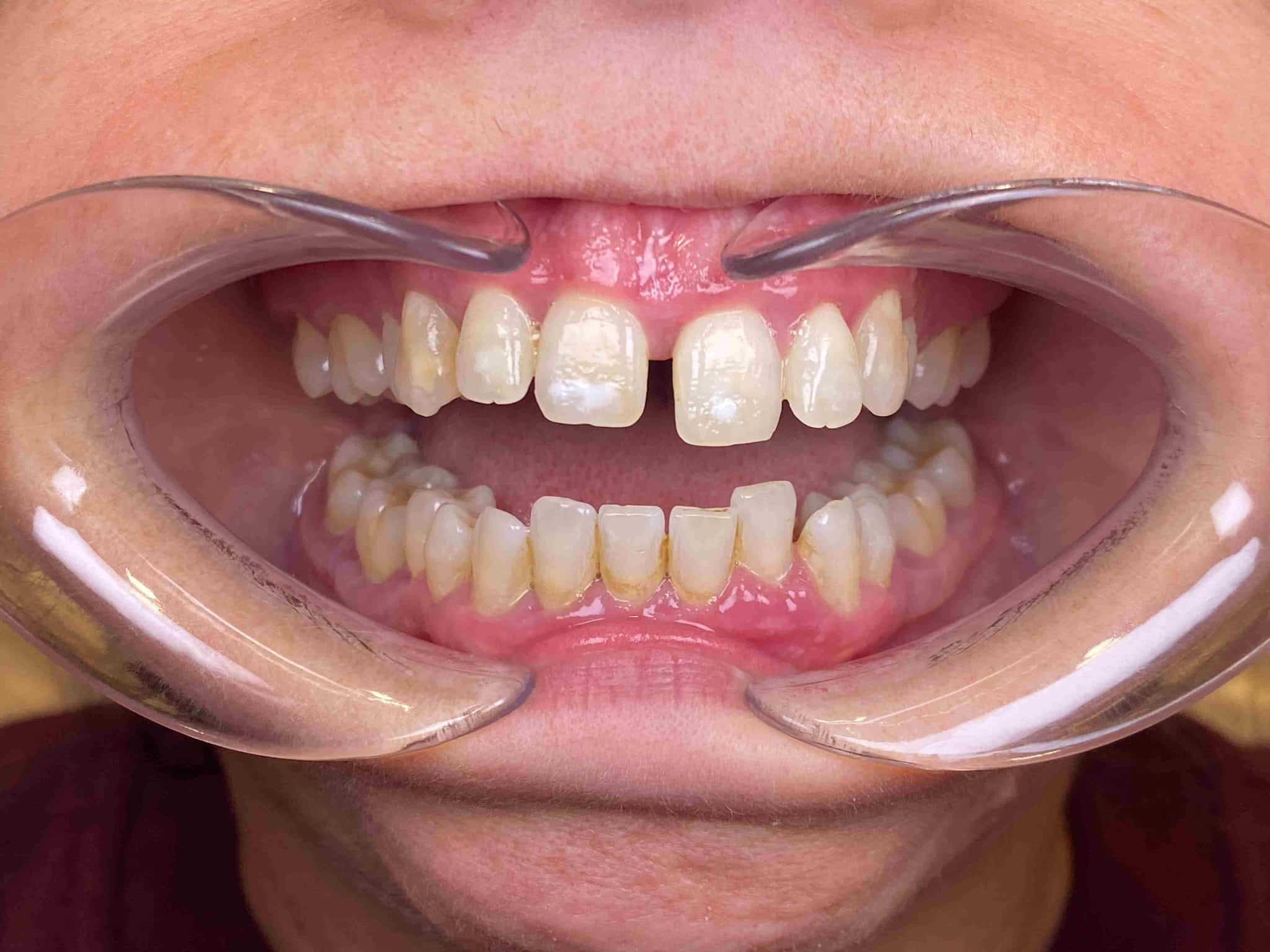 Apiñamiento dental: qué es, por qué ocurre y cómo se soluciona | ByB Dental
