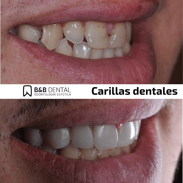 best veneers in malaga