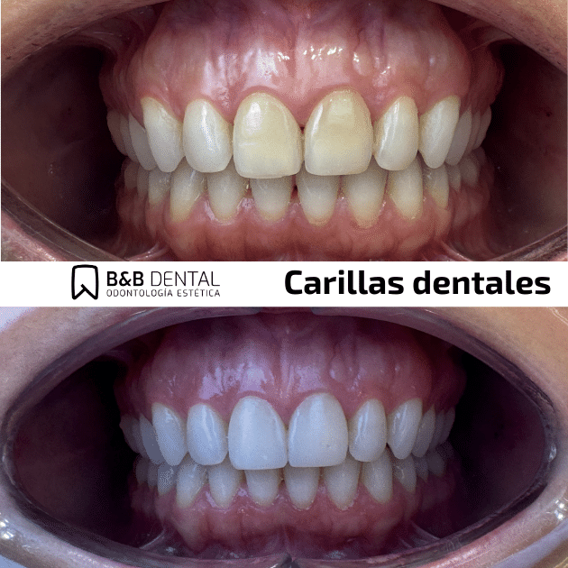 dental veneers malaga