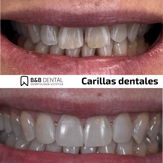 clip on veneers malaga