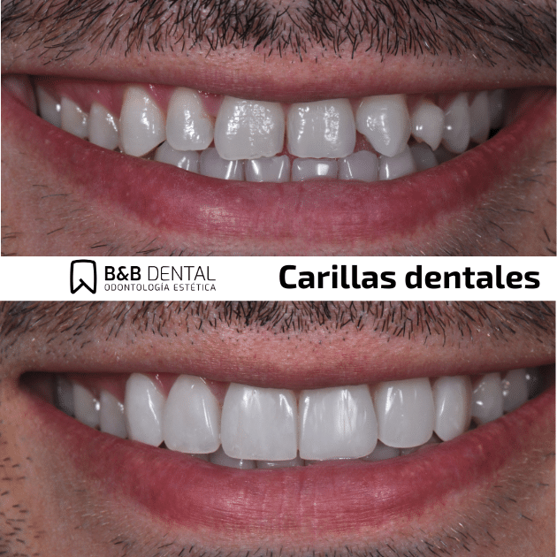 veneers teeth malaga
