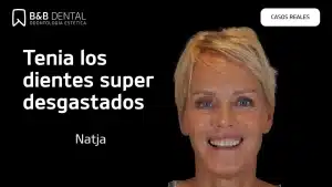 Natja Carillas de Ceramica BYB CASOS REALES Copy ByB Dental - Dentista en Málaga