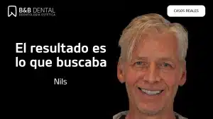 Nils Carillas de Ceramica BYB CASOS REALES copy ByB Dental - Dentista en Málaga