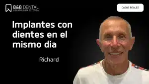 Richard carga inmediata BYB CASOS REALES copy ByB Dental - Dentista en Málaga