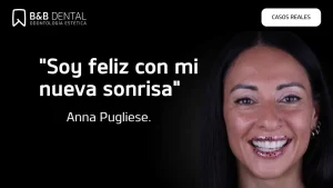 Anna Pugliese Anna Pugliese, caso de éxito en ByB Dental con su blanqueamiento dental y carillas de composite.