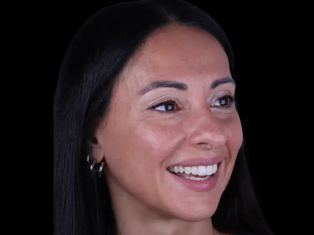 Anna Pugliese: Caso de Éxito en Estética Dental y Carillas en Málaga | ByB Dental