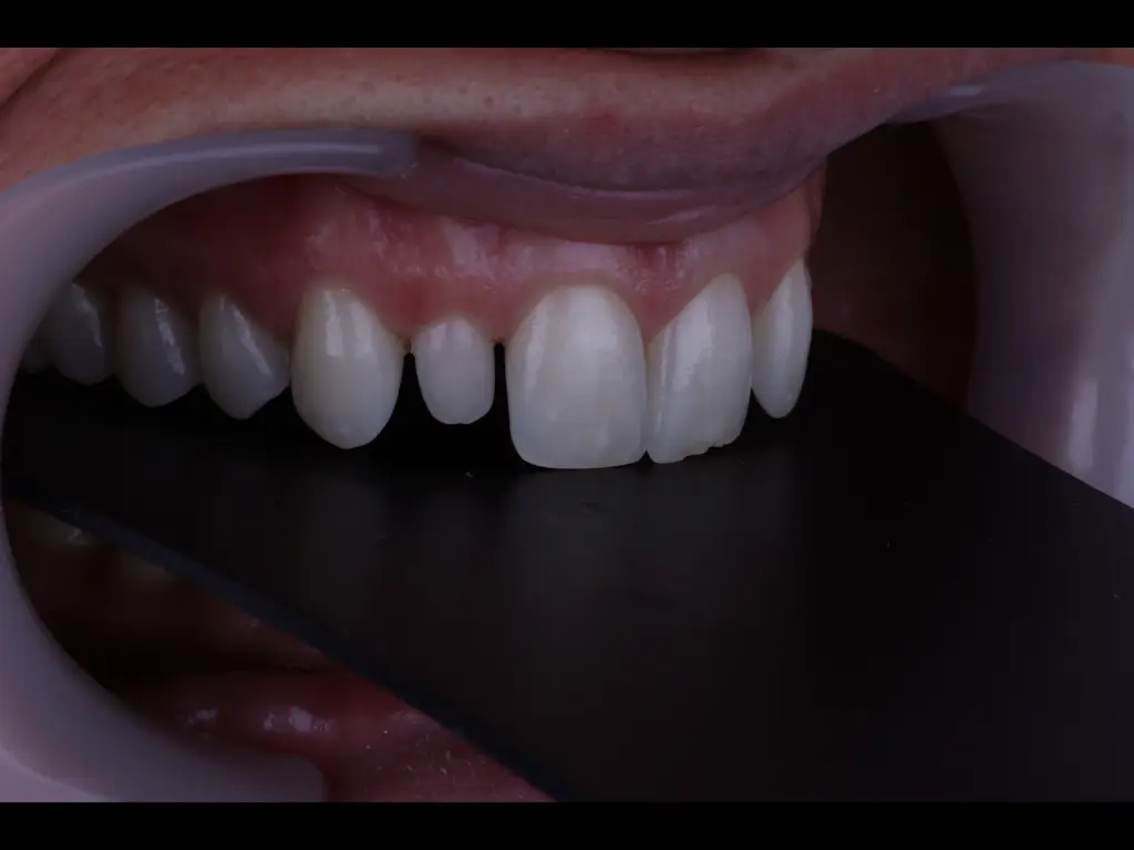 Anna Pugliese: Caso de Éxito en Estética Dental y Carillas en Málaga | ByB Dental