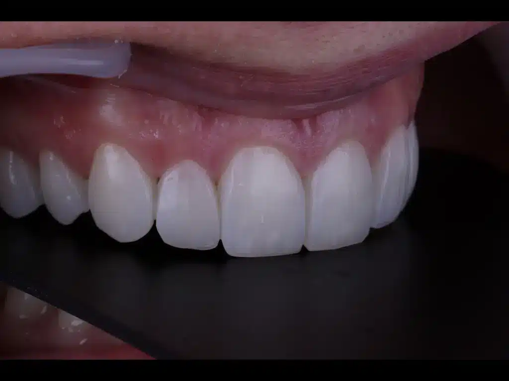 Anna Pugliese: Caso de Éxito en Estética Dental y Carillas en Málaga | ByB Dental